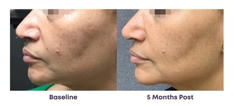 Before and after photos of Zula Modern Medspa pore texture treatment patient