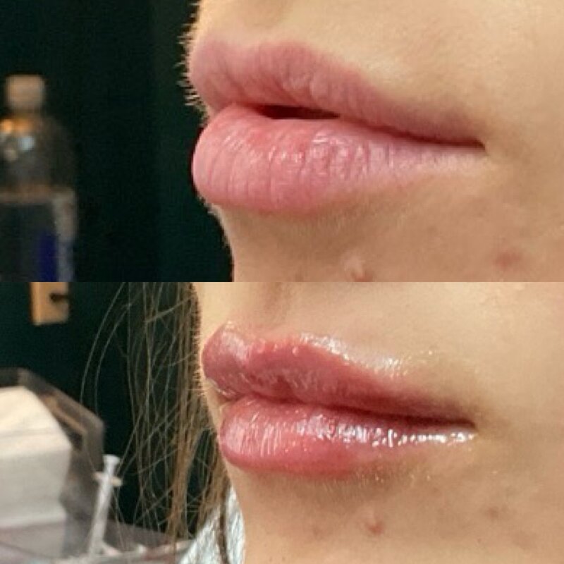 Before and after photos of Zula Modern Medspa volume loss treatment patient