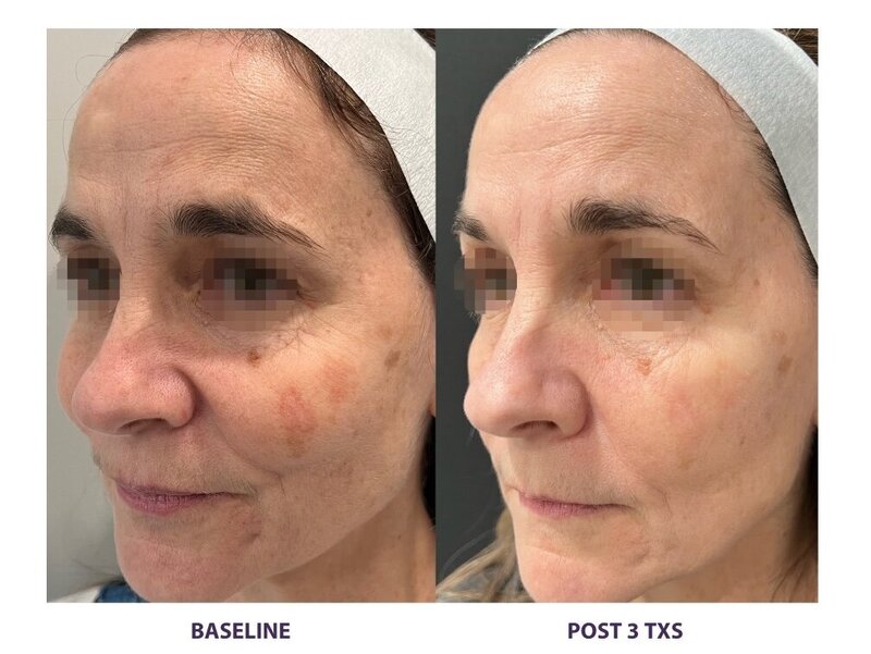 Before and after photos of Zula Modern Medspa wrinkle and fine line treatment patient