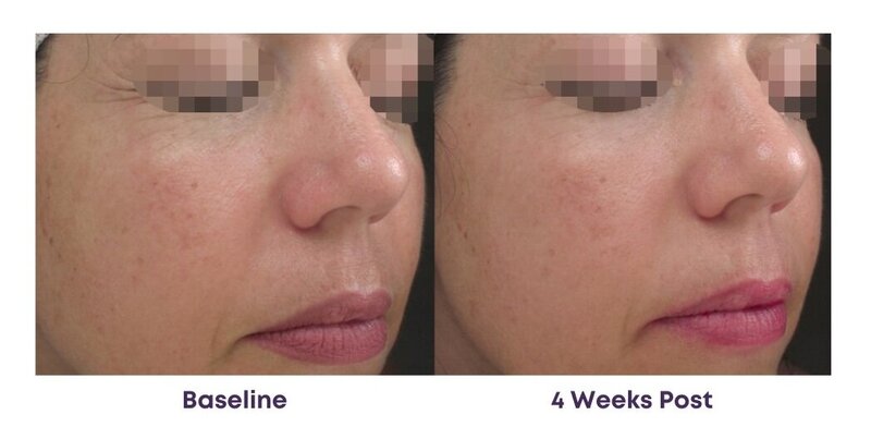 Before and after photos of Zula Modern Medspa hyperpigmentation treatment patient
