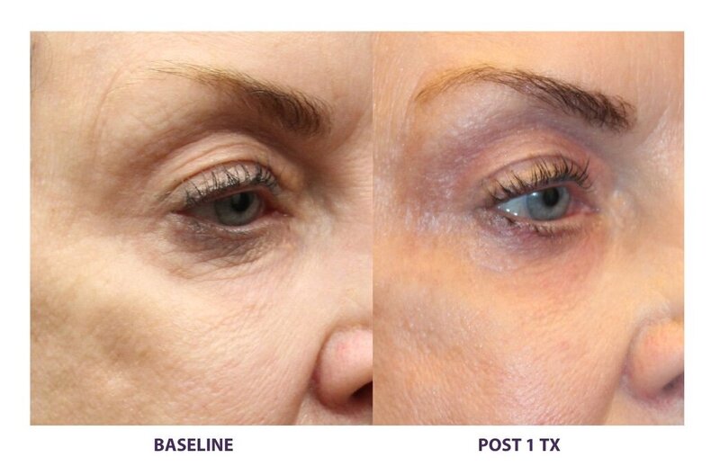 Before and after photos of Zula Modern Medspa sagging skin treatment patient