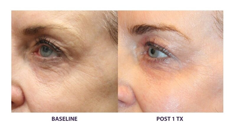 Before and after photos of Zula Modern Medspa wrinkle and fine line treatment patient