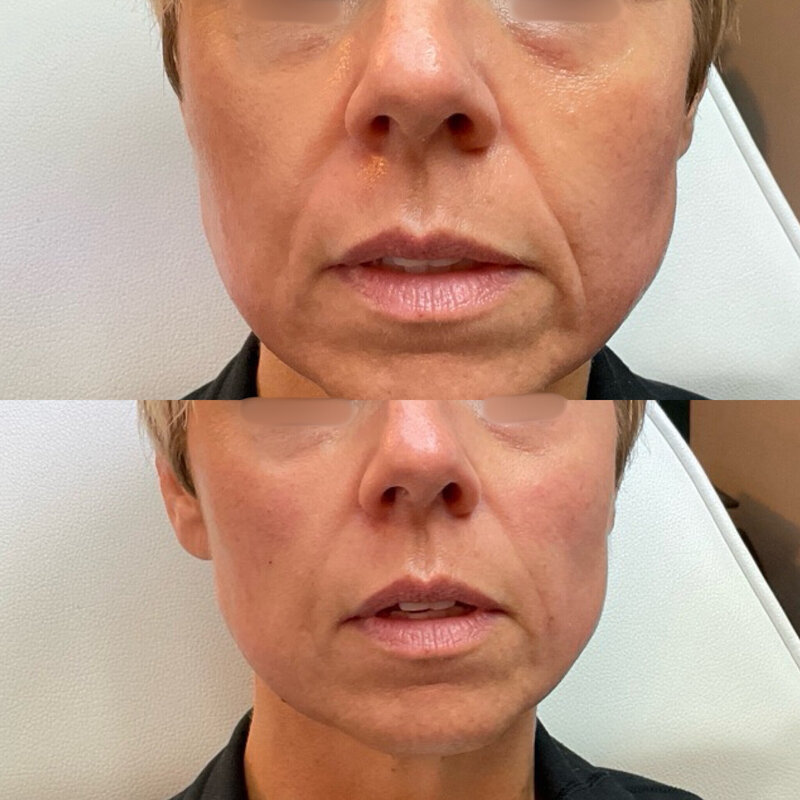 Before and after photos of Zula Modern Medspa volume loss treatment patient