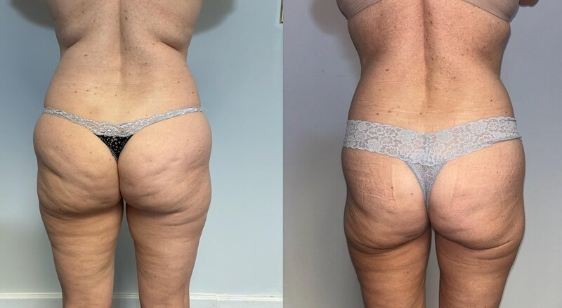 Before and after photos of Zula Modern Medspa sagging skin treatment patient