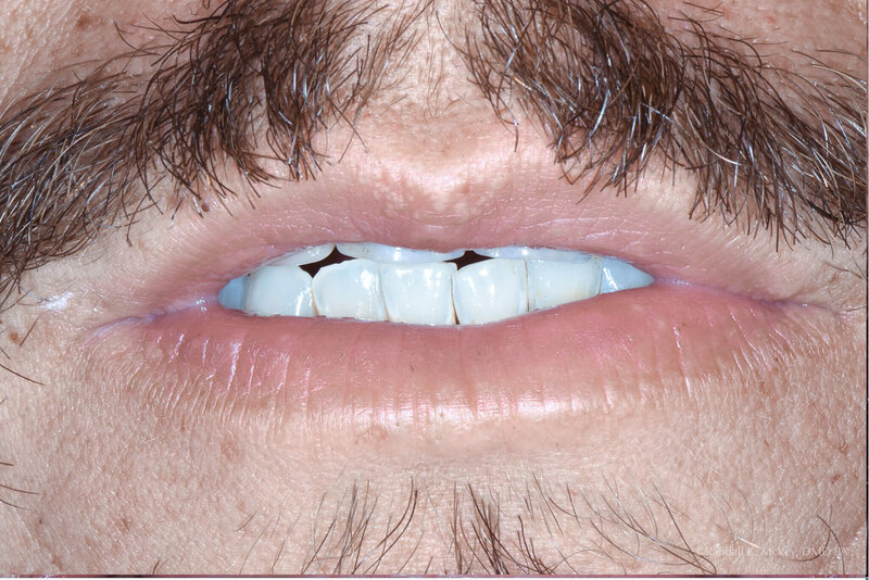 Example 1-A photo of  a patient's after  VENEERS & CROWNS