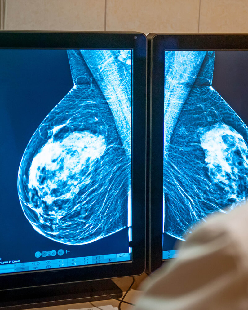 Digital breast model and physical phantom comparison used to enhance diagnostic accuracy and AI training