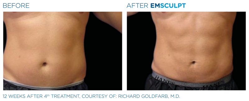 Emsculpt_PIC_Ba-card-male-abdomen-070_ENUS100
