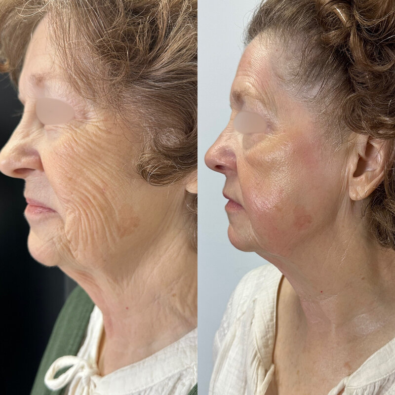 Before and after photos of Zula Modern Medspa double chin treatment patient
