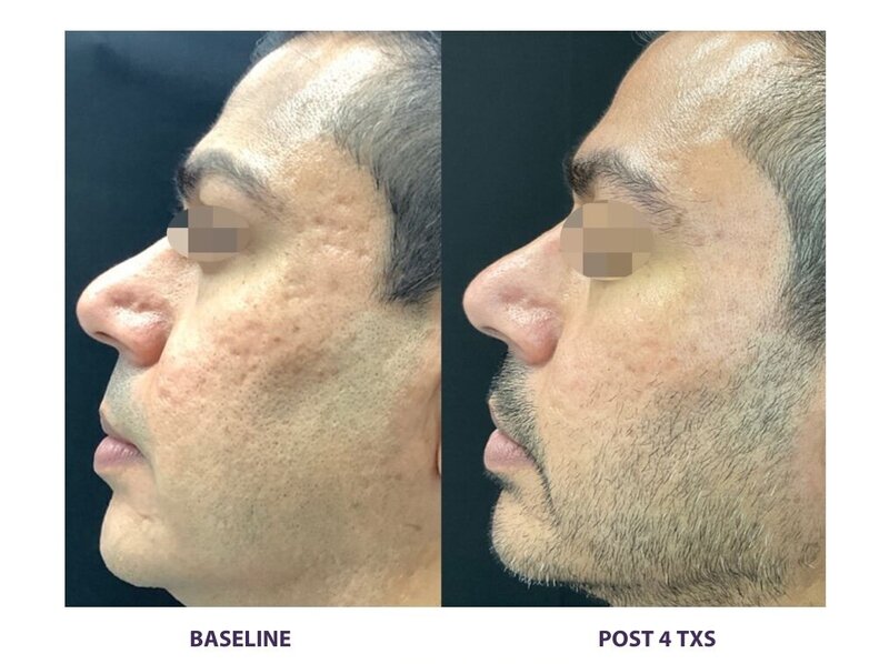 Before and after photos of Zula Modern Medspa discoloration treatment patient