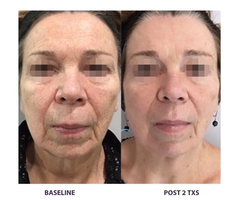 Before and after photos of Zula Modern Medspa sagging skin treatment patient