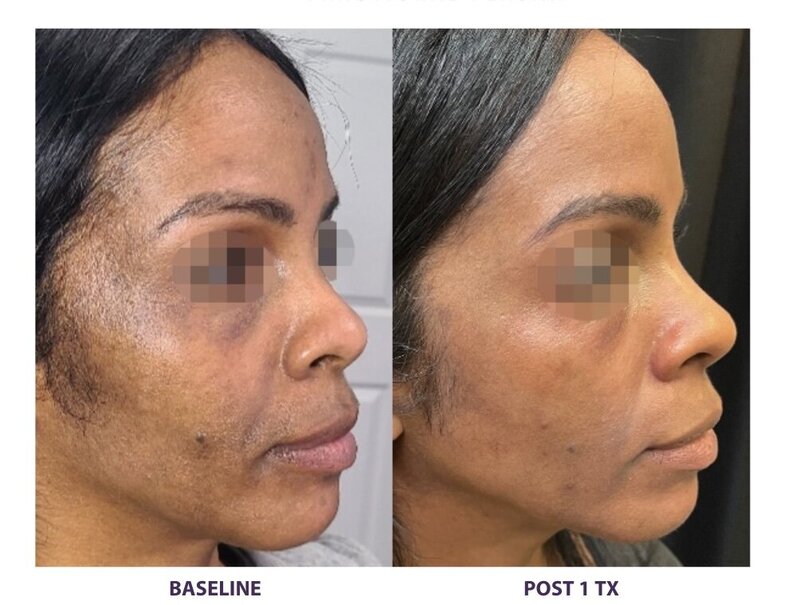 Before and after photos of Zula Modern Medspa hyperpigmentation treatment patient