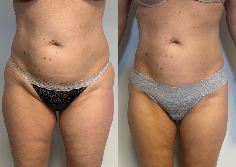 Before and after photos of Zula Modern Medspa stretch mark treatment patient