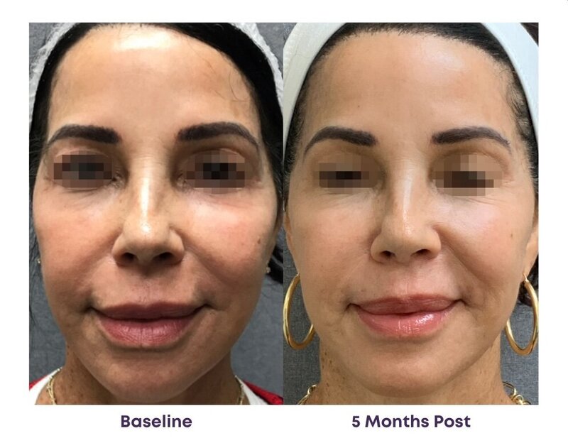 Before and after photos of Zula Modern Medspa sagging skin treatment patient