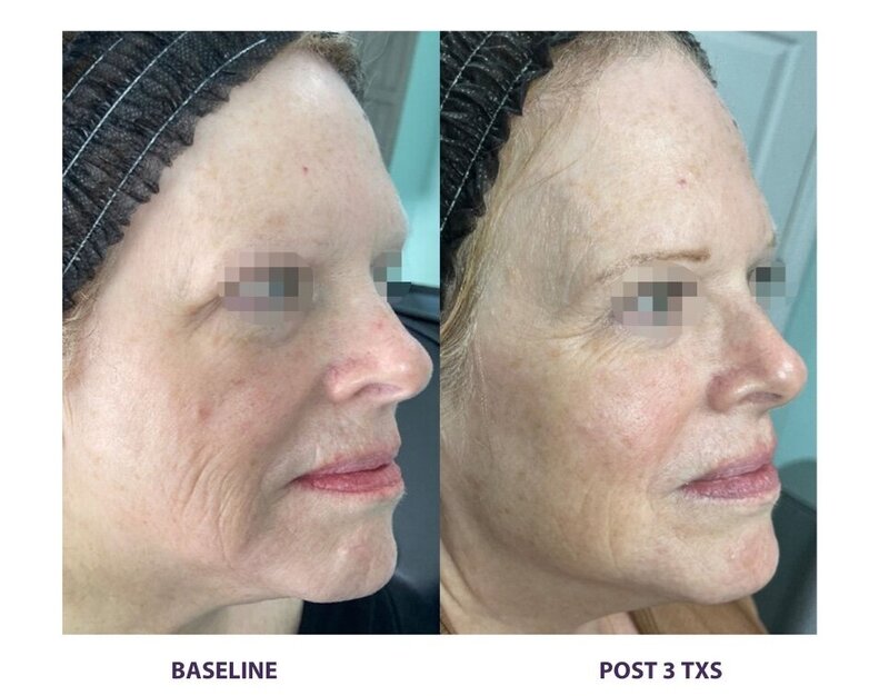 Before and after photos of Zula Modern Medspa sagging skin treatment patient