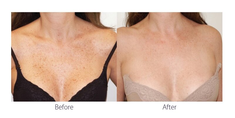 Before and after photos of Zula Modern Medspa hyperpigmentation treatment patient