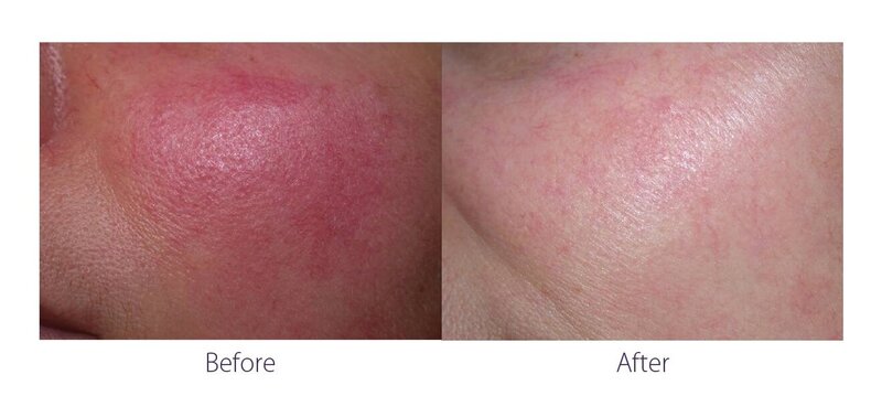 Before and after photos of Zula Modern Medspa rosacea treatment patient