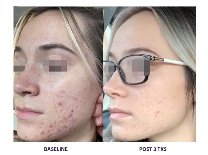 Before and after photos of Zula Modern Medspa facial treatment patient