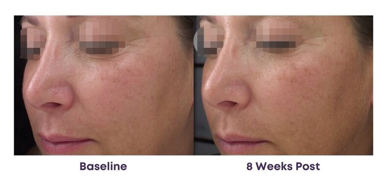 Before and after photos of Zula Modern Medspa rosacea treatment patient