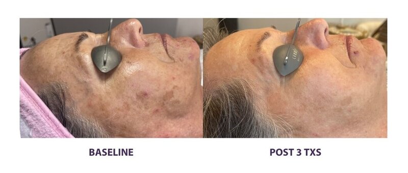 Before and after photos of Zula Modern Medspa anti-aging treatment patient