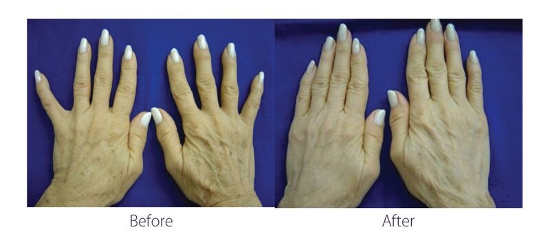 Before and after photos of Zula Modern Medspa discoloration treatment patient