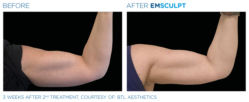 Emsculpt_PIC_Ba-card-female-arms-113_ENUS100