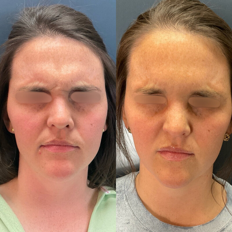 Before and after photos of Zula Modern Medspa wrinkle and fine line treatment patient