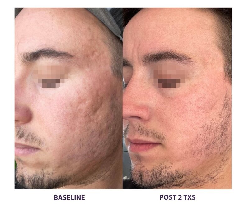 Before and after photos of Zula Modern Medspa pore texture treatment patient