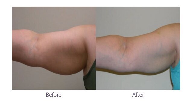 Before and after photos of Zula Modern Medspa sagging skin treatment patient
