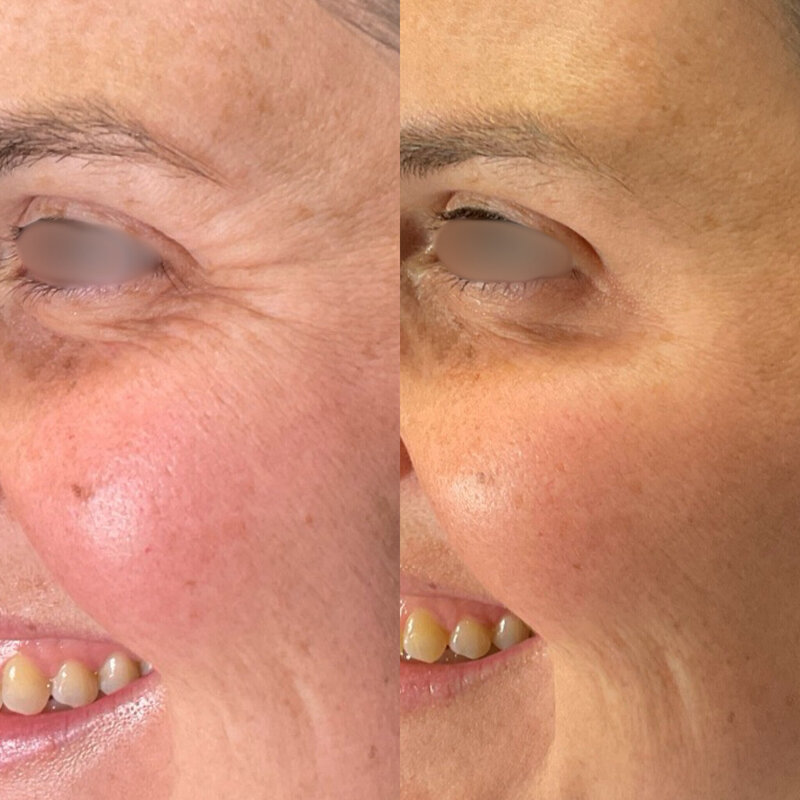 Before and after photos of Zula Modern Medspa botox treatment patient