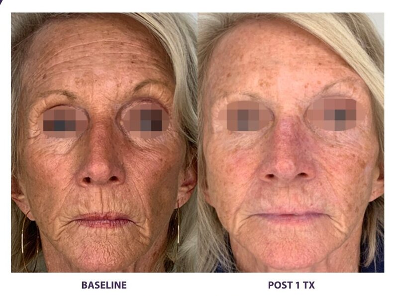 Before and after photos of Zula Modern Medspa sagging skin treatment patient