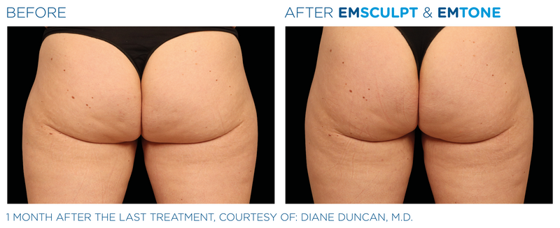 Emsculpt_Emtone_PIC_Ba-card-female-buttock-013_ENUS100