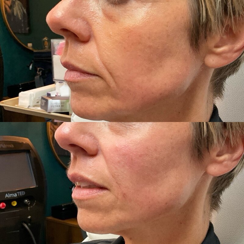 Before and after photos of Zula Modern Medspa sagging skin treatment patient