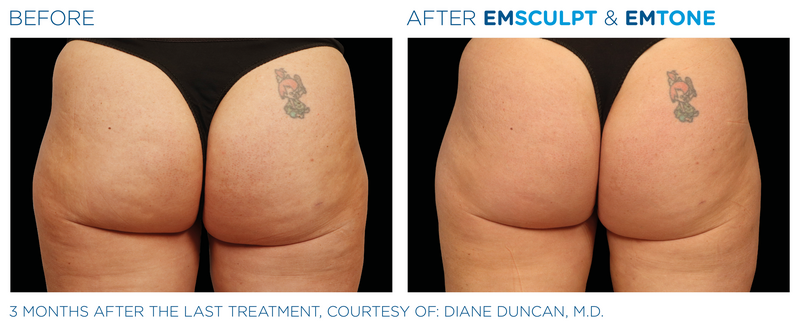 Emsculpt_Emtone_PIC_Ba-card-female-buttock-018_ENUS100