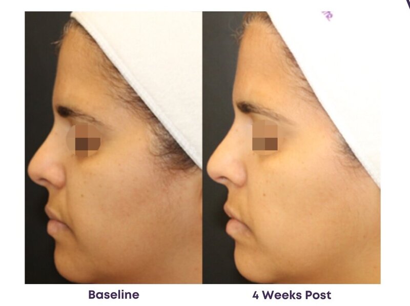 Before and after photos of Zula Modern Medspa hyperpigmentation treatment patient