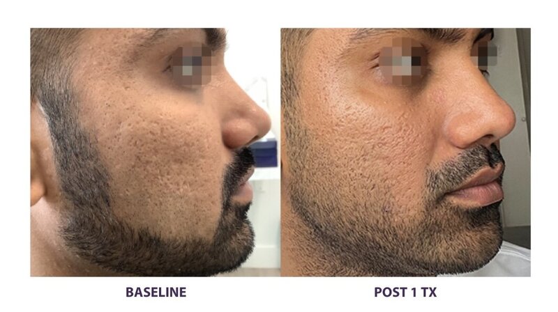 Before and after photos of Zula Modern Medspa acne treatment patient
