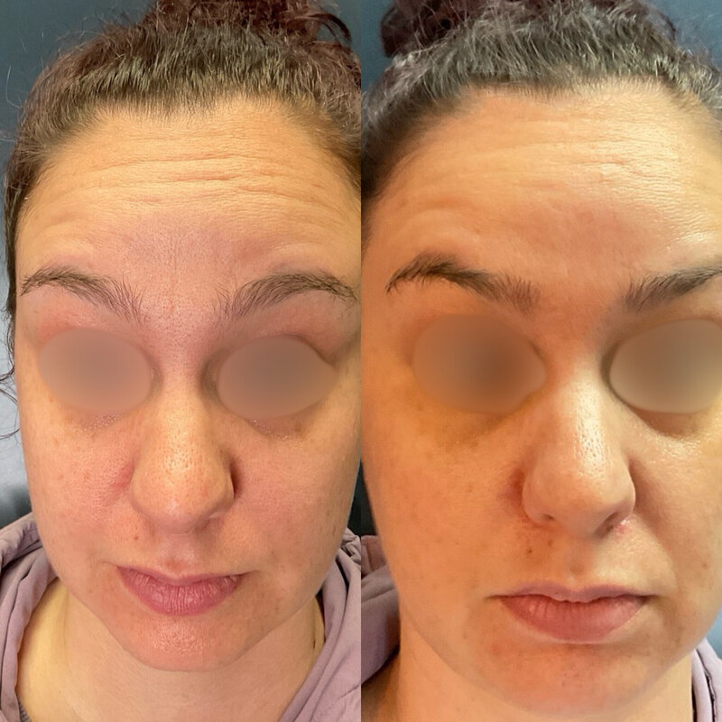 Before and after photos of Zula Modern Medspa botox treatment patient