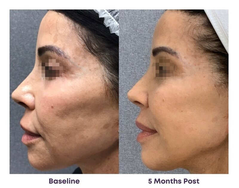 Before and after photos of Zula Modern Medspa discoloration treatment patient