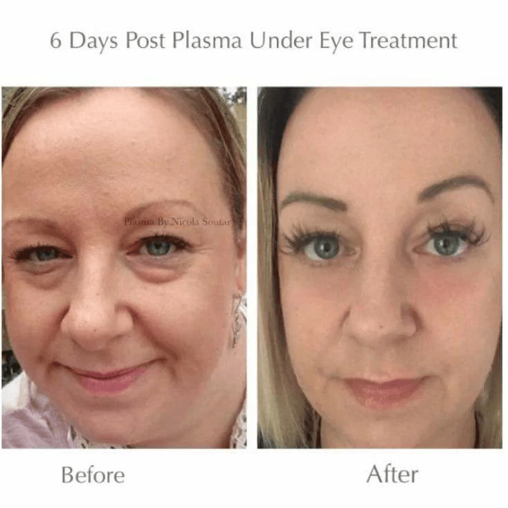 Eyebags-removal-plasma-pen-remove-top-and-bottom-content-tidy-1