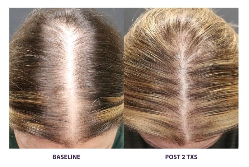 Before and after photos of Zula Modern Medspa hair thinning treatment patient