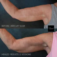 arm-lift-scar-camouflage-2 (1)