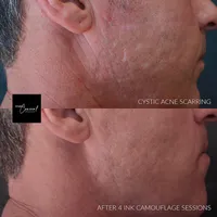 acne scar revision tattoo