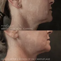 acne scar revision tattoo