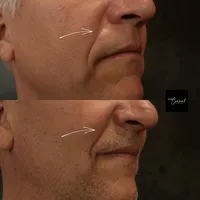 scar camouflage