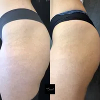 Candida-right-2