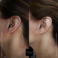 scar camouflage