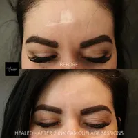 forehead-burn-scar-removal