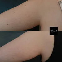 stretch-mark-arms-left-back-2