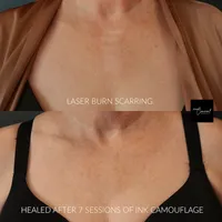 scar camouflage