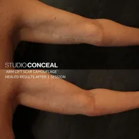 Arm-Lift-Skin-Tattoo