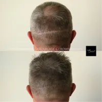 Hair-Loss-Density-Tattoo-2